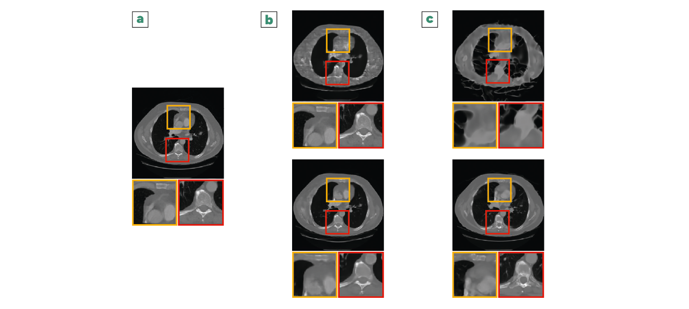 Trois séries d'images médicales en coupe transversale montrent des zones encadrées en jaune et rouge avec des zooms détaillés en dessous pour chaque série.
Description générée par IA